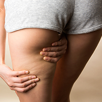 セルライト セルライト